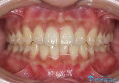 前歯のがたつきをすっきり マウスピース矯正の治療中