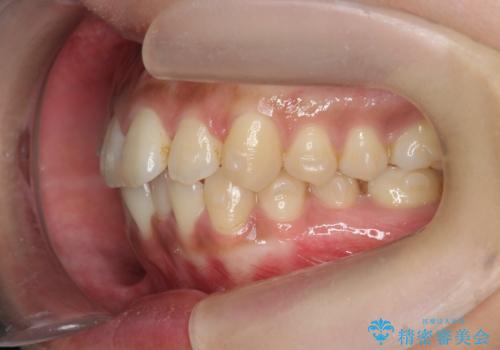 前歯のがたつきをすっきり マウスピース矯正の治療中