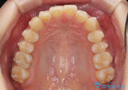 前歯のがたつきをすっきり マウスピース矯正の治療中