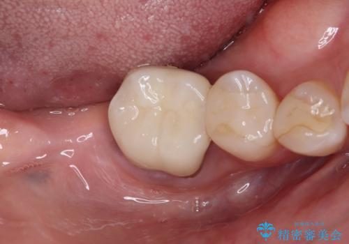 放置した奥歯 部分矯正を併用したインプラント補綴治療の治療前