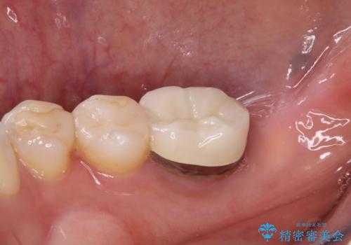 放置した奥歯 部分矯正を併用したインプラント補綴治療の治療前