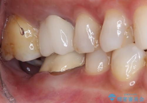 放置した奥歯 部分矯正を併用したインプラント補綴治療の治療前