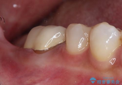 放置した奥歯 部分矯正を併用したインプラント補綴治療の治療前