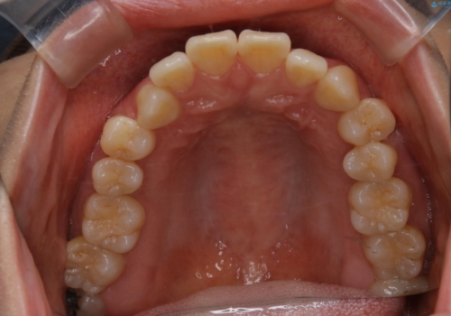 最小限の来院回数で歯並びを改善:インビザライン治療の治療前