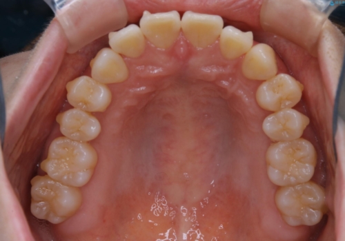 最小限の来院回数で歯並びを改善:インビザライン治療の治療中