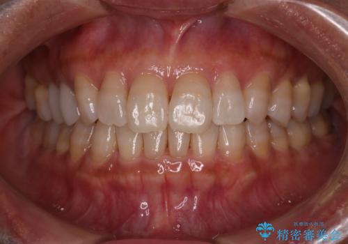 【インビザライン】下前歯だけを治したいの治療後