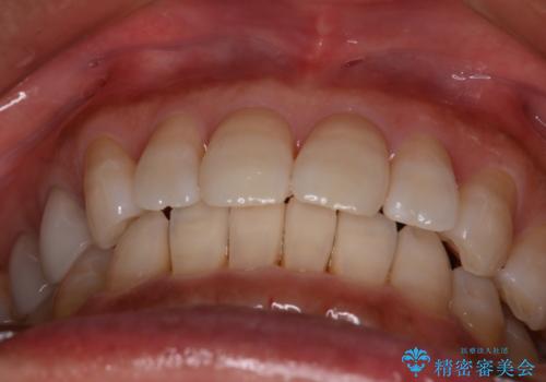 【インビザライン】下前歯だけを治したいの治療後