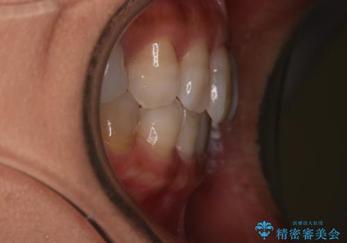 【インビザライン】下前歯だけを治したいの治療後