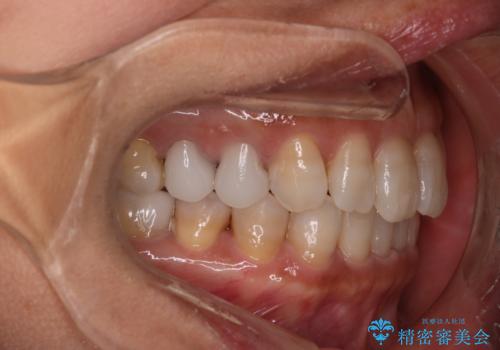 【インビザライン】下前歯だけを治したいの治療後