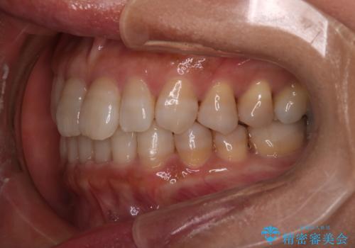 【インビザライン】下前歯だけを治したいの治療後