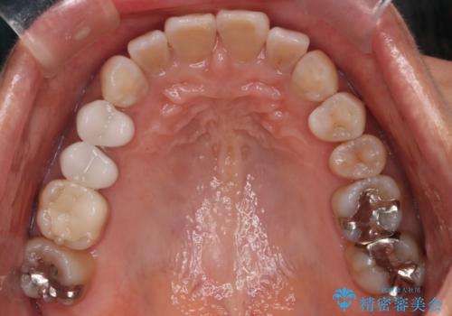 【インビザライン】下前歯だけを治したいの治療後