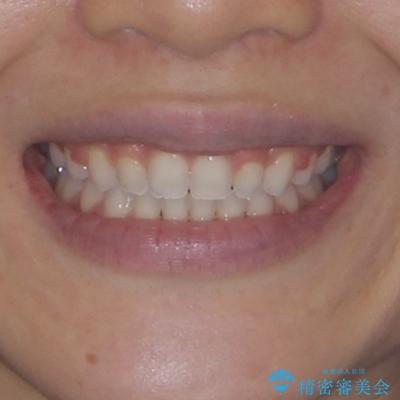 前歯のデコボコとクロスバイト ワイヤー装置での抜歯矯正の治療後(顔貌)