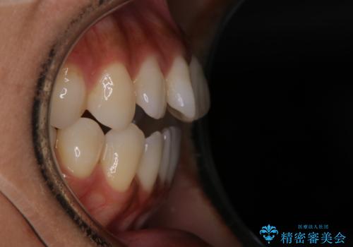 【モニター】開咬(オープンバイト)を治したい ワイヤー装置の治療前