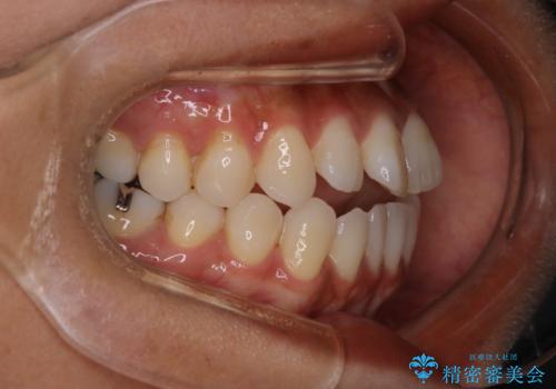 【モニター】開咬(オープンバイト)を治したい ワイヤー装置の治療前