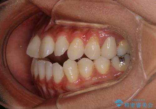 【モニター】開咬(オープンバイト)を治したい ワイヤー装置の治療前