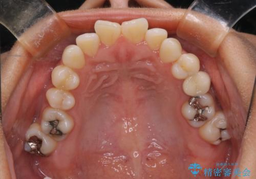 【モニター】開咬(オープンバイト)を治したい ワイヤー装置の治療前