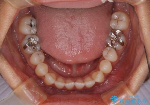 【モニター】開咬(オープンバイト)を治したい ワイヤー装置の治療前