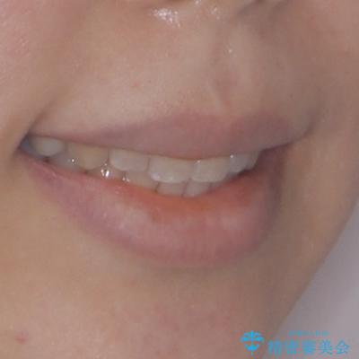 八重歯と上顎前突 ワイヤー装置での抜歯矯正の治療後(顔貌)