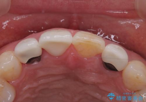 前歯のセラミッククラウン 詰め物が取れたの治療後
