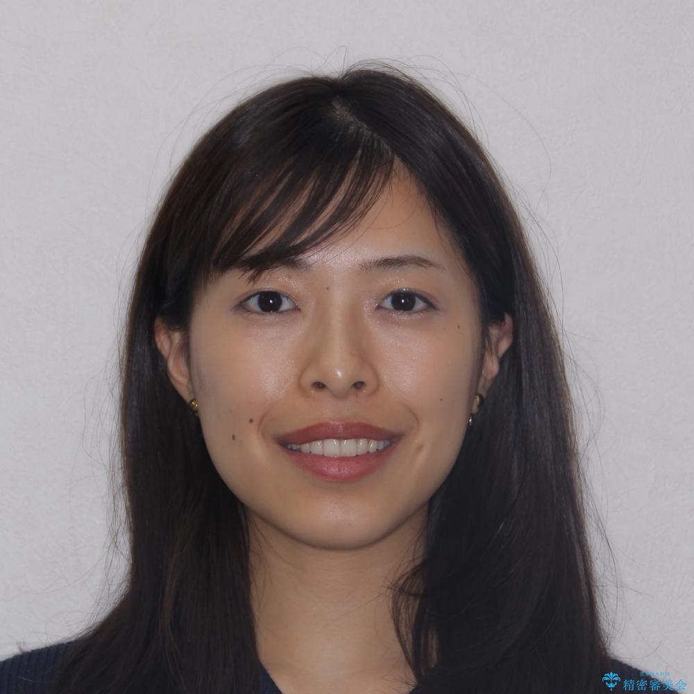 【モニター】突出した前歯 補助装置を併用したインビザライン矯正の治療後(顔貌)