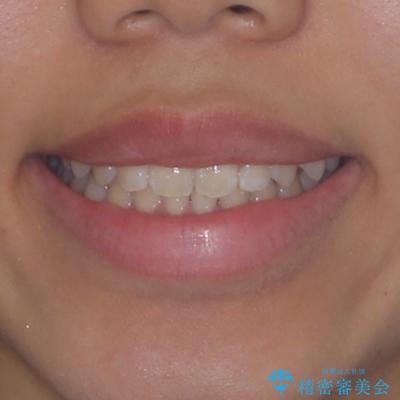 気になるすきっ歯を短期間で改善 インビザライン矯正の治療後(顔貌)