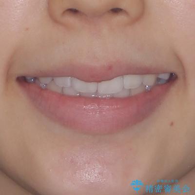 抜歯矯正の軽度後戻りを解消 インビザライン矯正の治療後(顔貌)