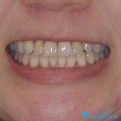 前歯のクロスバイト インビザラインによる矯正治療の治療後(顔貌)