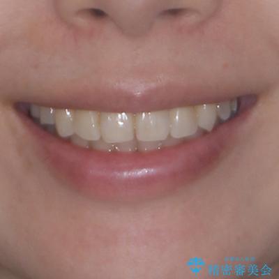 インビザラインによる矯正治療と奥歯のインプラント治療の治療後(顔貌)