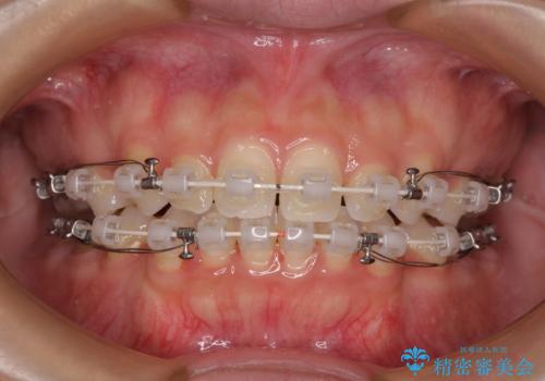 前歯のデコボコとクロスバイト ワイヤー装置での抜歯矯正の治療中