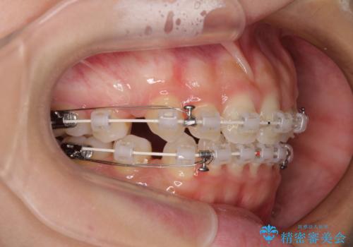 前歯のデコボコとクロスバイト ワイヤー装置での抜歯矯正の治療中