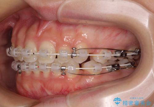 前歯のデコボコとクロスバイト ワイヤー装置での抜歯矯正の治療中