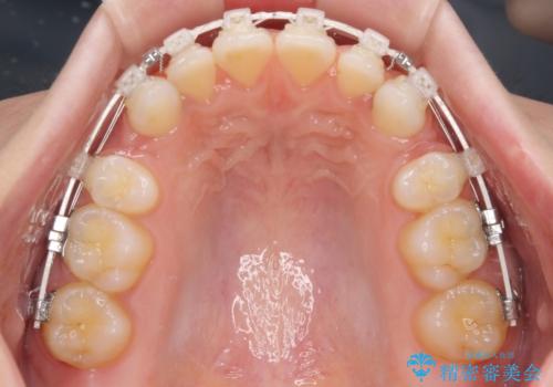 前歯のデコボコとクロスバイト ワイヤー装置での抜歯矯正の治療中
