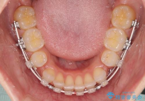 前歯のデコボコとクロスバイト ワイヤー装置での抜歯矯正の治療中