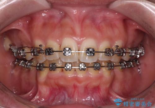 八重歯と上顎前突 ワイヤー装置での抜歯矯正の治療中
