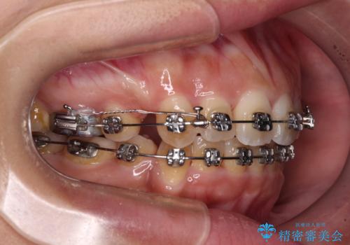八重歯と上顎前突 ワイヤー装置での抜歯矯正の治療中