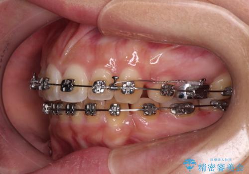 八重歯と上顎前突 ワイヤー装置での抜歯矯正の治療中