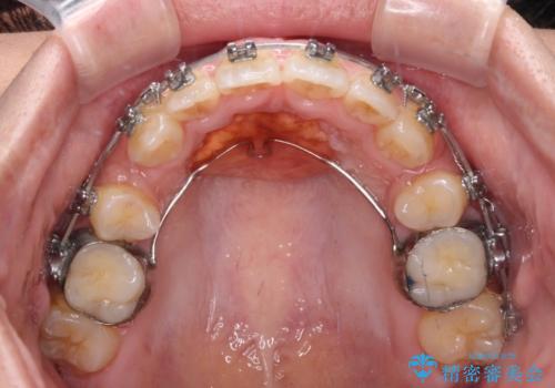 八重歯と上顎前突 ワイヤー装置での抜歯矯正の治療中