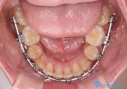 八重歯と上顎前突 ワイヤー装置での抜歯矯正の治療中