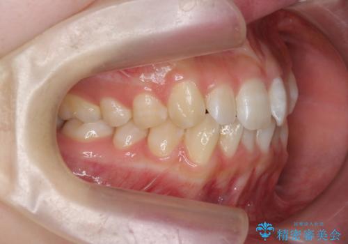 前歯のねじれを治したい マウスピース矯正治療の治療前