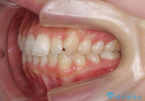 前歯のねじれを治したい マウスピース矯正治療の治療前