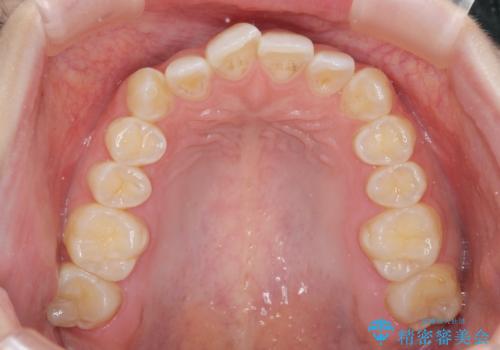 前歯のねじれを治したい マウスピース矯正治療の治療前