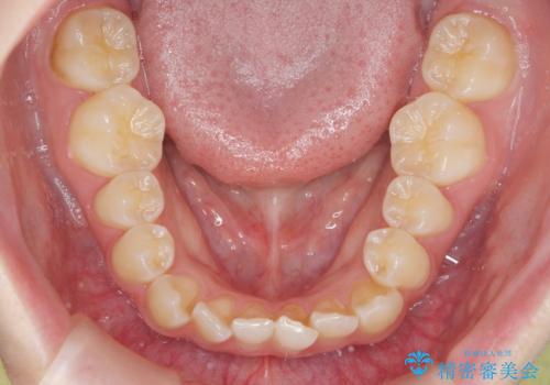 前歯のねじれを治したい マウスピース矯正治療の治療前