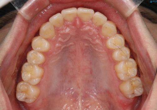 低予算・短期間での歯並び改善:インビザライン治療の治療後
