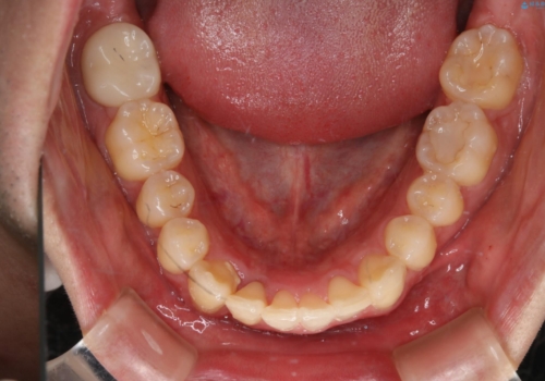 低予算・短期間での歯並び改善:インビザライン治療の治療後