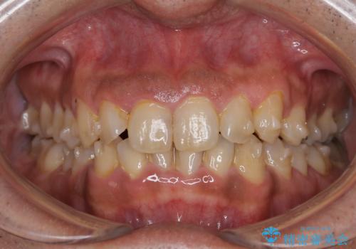 しぶといステインもエアフローワンで1日でキレイに!!の治療前