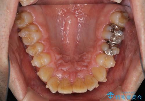 しぶといステインもエアフローワンで1日でキレイに!!の治療前