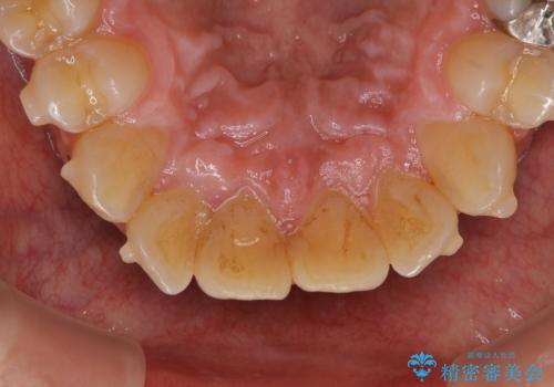 しぶといステインもエアフローワンで1日でキレイに!!の治療前