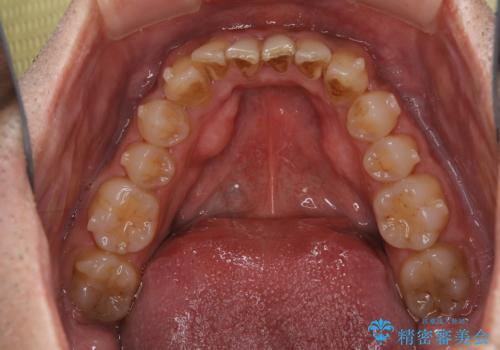しぶといステインもエアフローワンで1日でキレイに!!の治療前