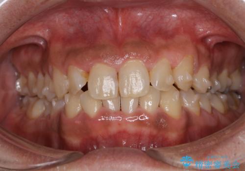 しぶといステインもエアフローワンで1日でキレイに!!の治療後