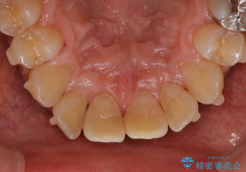 しぶといステインもエアフローワンで1日でキレイに!!の治療後